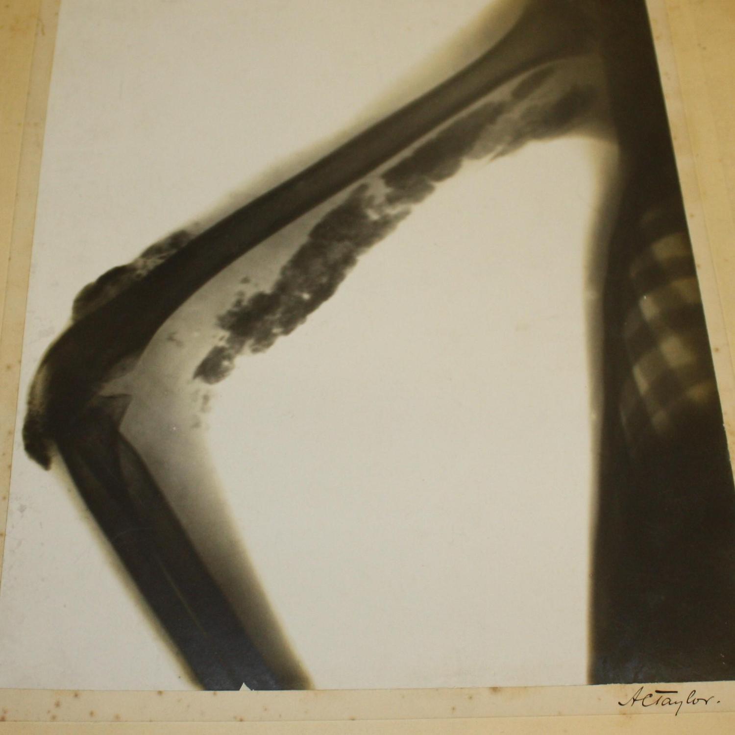An Early X-Ray produced by Alfred Caleb Talor